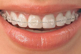 aligners and braces clinic porbandar