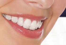 aligners and braces clinic porbandar