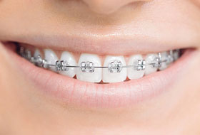 aligners and braces clinic porbandar