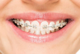 aligners and braces clinic porbandar
