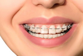 aligners and braces clinic porbandar