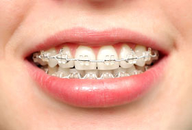aligners and braces clinic porbandar