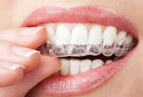 aligners and braces clinic porbandar