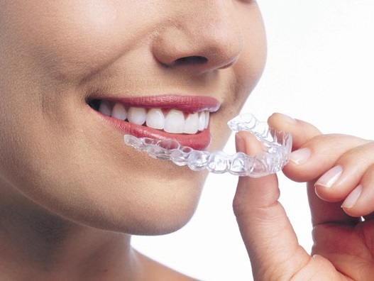 Braces and Aligner porbandar