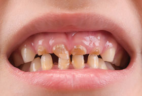 child dentistry in porbandar