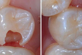 Composite Restoration in Porbandar