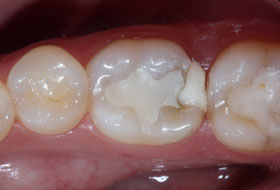 Composite Restoration in Porbandar