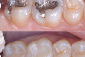 Composite Restoration in Porbandar