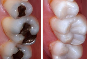 Composite Restoration in Porbandar