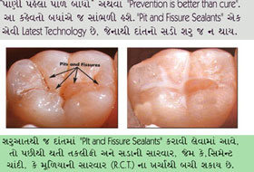 Composite Restoration in Porbandar