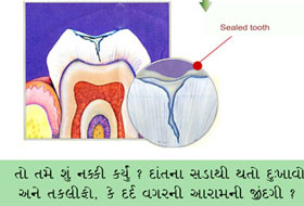 Composite Restoration in Porbandar