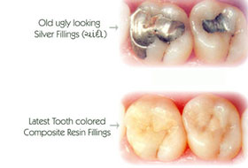 Composite Restoration in Porbandar