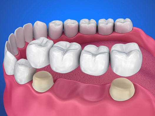crowns and bridges treatment in porbandar