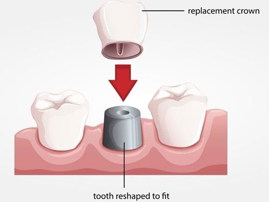 crowns and bridges treatment in porbandar