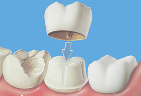 crowns and bridges treatment in porbandar