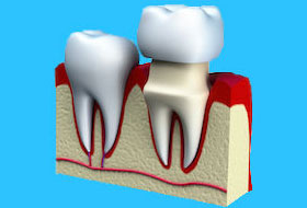 crowns and bridges treatment in porbandar