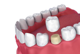 crowns and bridges treatment in porbandar