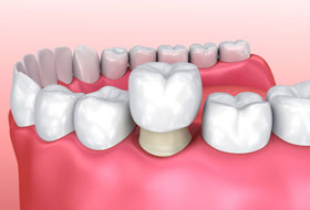 crowns and bridges treatment in porbandar