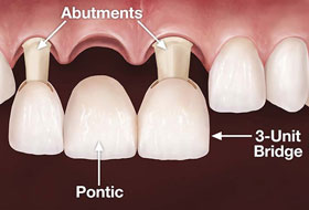 crowns and bridges treatment in porbandar