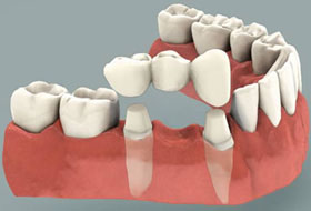 crowns and bridges treatment in porbandar