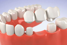 crowns and bridges treatment in porbandar