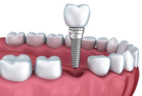 Dental Implant