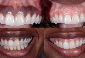 Gum Depigmentation clinic in porbandar