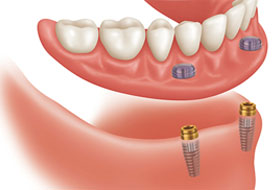 implant supported dentures clinic in porbandar