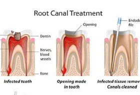 Root Canal Treatment gujarat