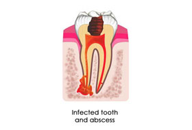 Root Canal Treatment clinic porbandar