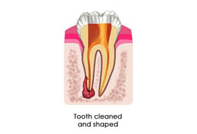 Root Canal Treatment clinic in gujarat