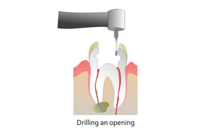 Root Canal Treatment