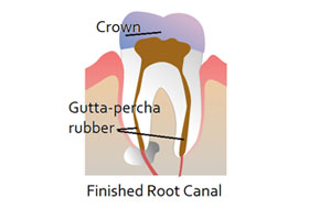Root Canal Treatment
