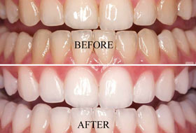 scaling and polishing treatment in porbandar