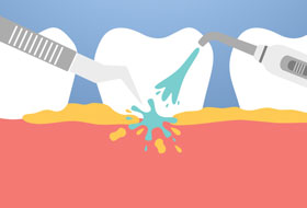 scaling and polishing treatment in porbandar