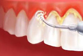 scaling and polishing treatment in porbandar