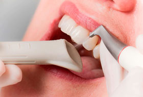 scaling and polishing treatment in porbandar