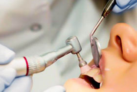 scaling and polishing treatment in porbandar