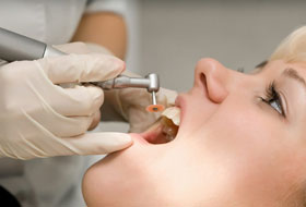 scaling and polishing treatment in porbandar