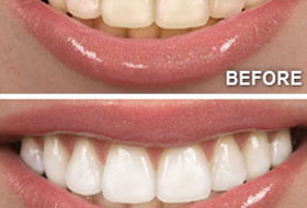 Smile Designing in porbandar