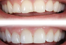 Smile Designing in gujarat