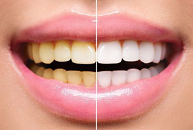 Teeth Whitening india