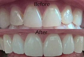 veneers and laminates