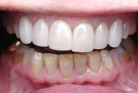 Veneers and Laminates