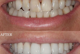 Veneers and Laminates Clinic in Porbandar