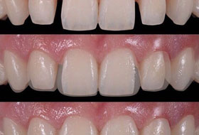 veneers and laminates in porbandar