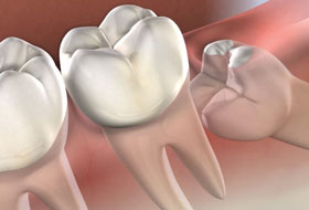 wisdom teeth surgery